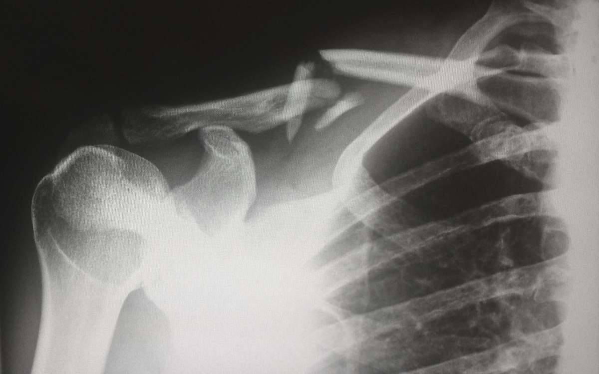 x-ray human X-ray result chart ct scan